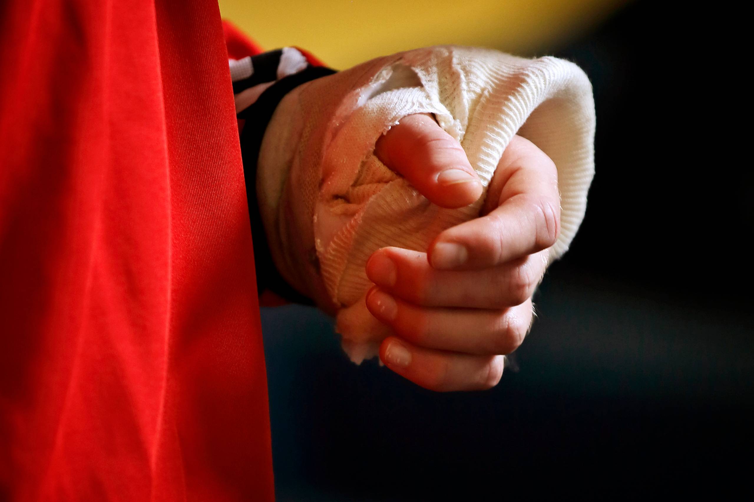 Nicolai Jørgensen med sin brækkede hånd. Foto: Jens Dresling