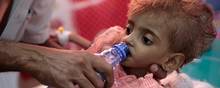 Borgerrkrigen i Yemen er ifølge FN verdens værste humanitære krise. Her hjælpes en lille pige. Krigen er udvidet til et stedfortræderopgør mellem de store rivaler Saudi-Arabien og Iran.
Arkivfoto: Hani Mohammed/AP