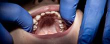 Unge i alderen 18-21 år kan snart se frem til vederlagsfri tandlægebesøg. Tandlægerne advarer dog om mangler i loven. Arkivfoto: Katinka Husted/Ritzau Scanpix