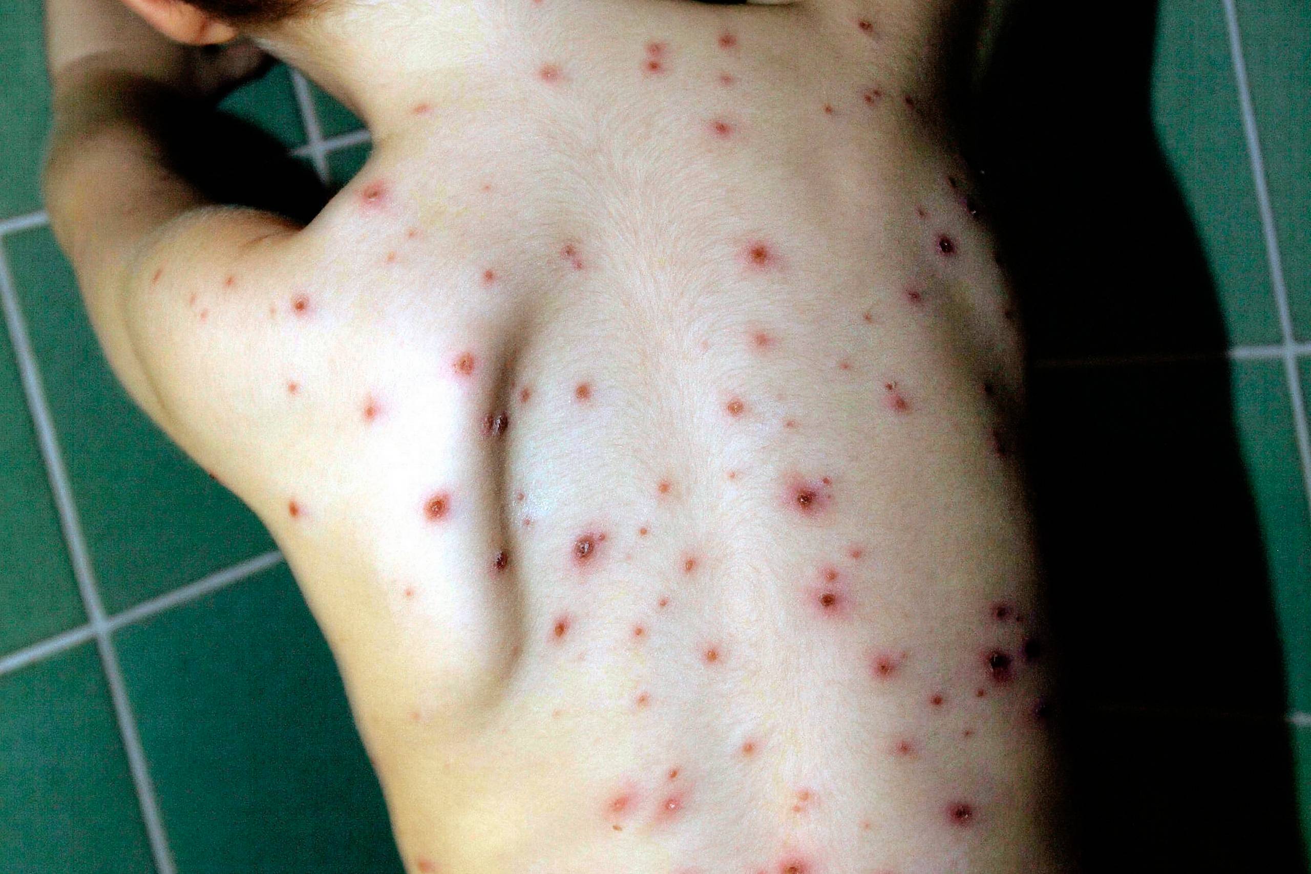 Fireårig dreng med børnesygdommen skoldkopper. Foto: Thomas Borberg