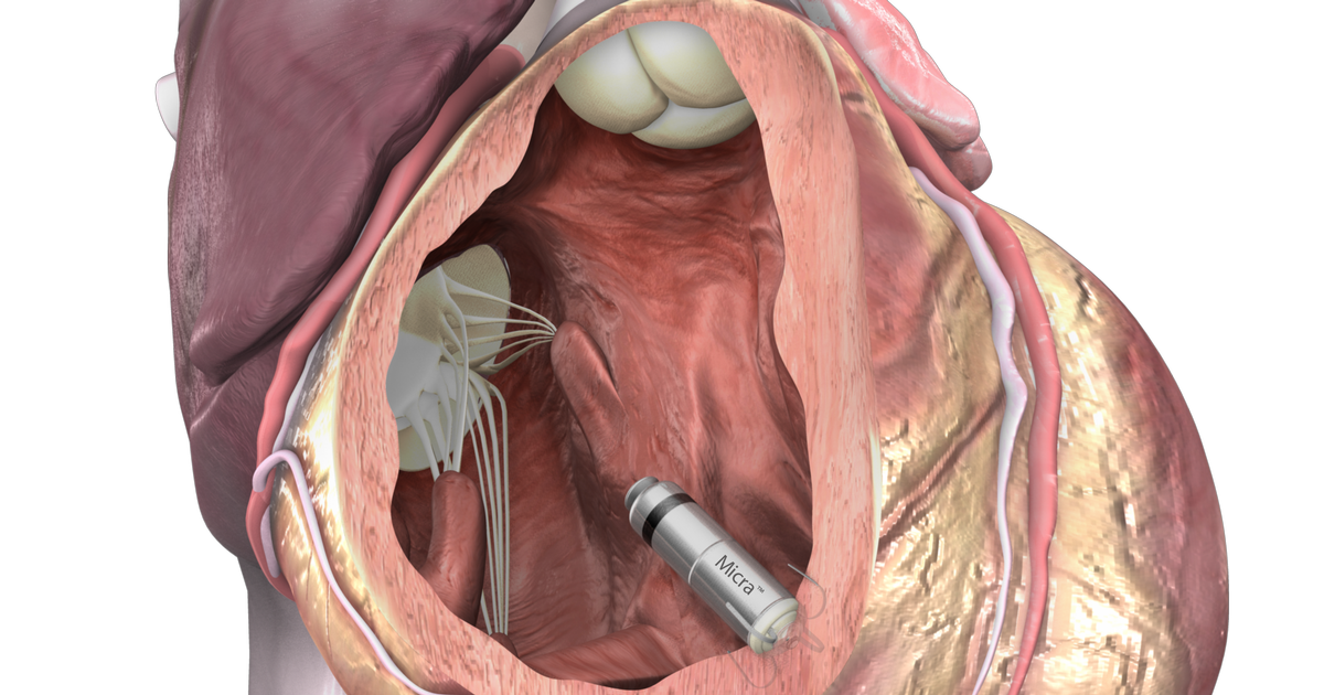 Verdens mindste pacemaker er kommet til Danmark - Jyllands-Posten